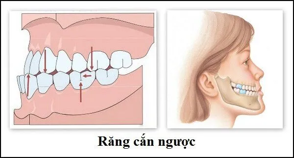 Răng móm (khớp cắn ngược)