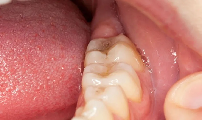Biểu hiện của việc sưng lợi trong cùng là gì?