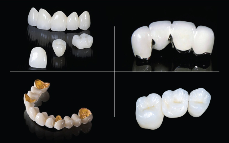 Răng sứ gồm những loại nào?