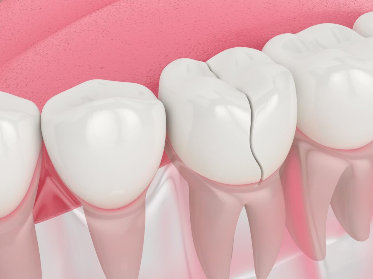 Răng sứ bị nứt hoặc vỡ khi sinh hoạt
