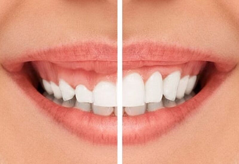 Cắt lợi là gì?