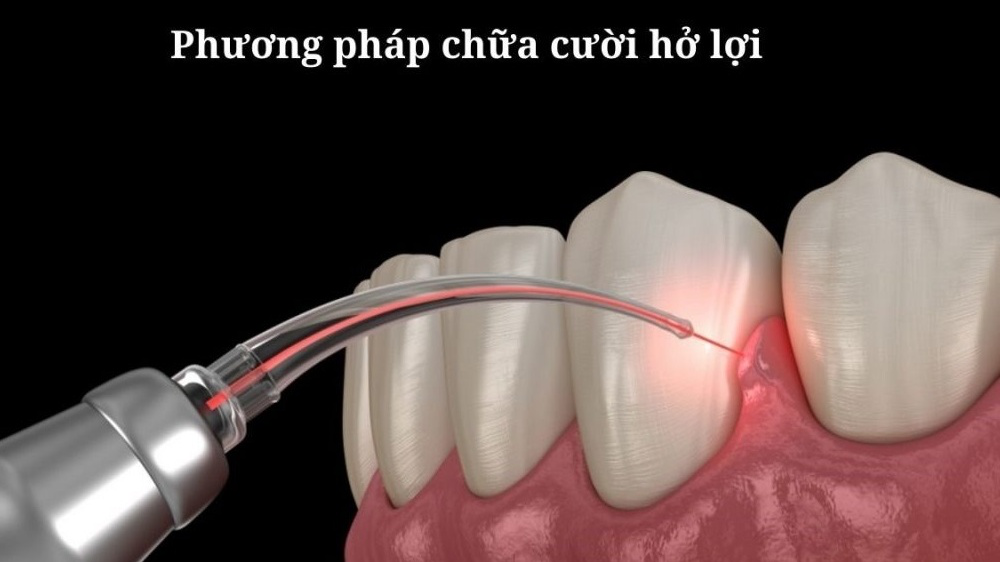 Chi phí cắt lợi bằng công nghệ Laser hiện đại