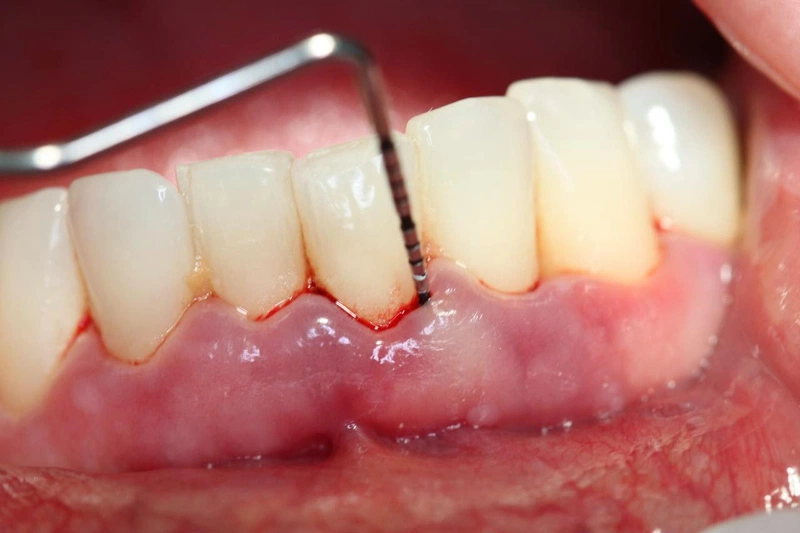 Chi phí Cắt lợi bằng dao phẫu thuật truyền thống