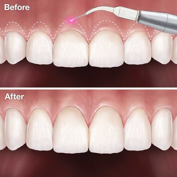 Số lượng răng cần cắt lợi