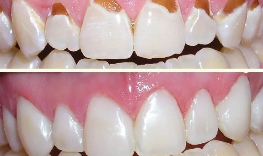 Giảm tính thẩm mỹ