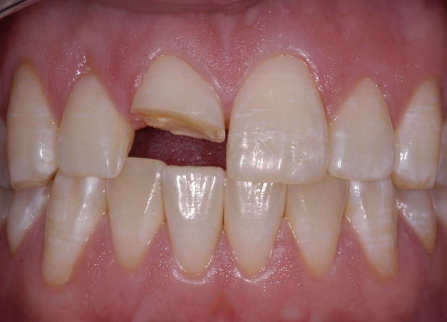 Chất lượng răng sứ kém chất lượng và kém bền