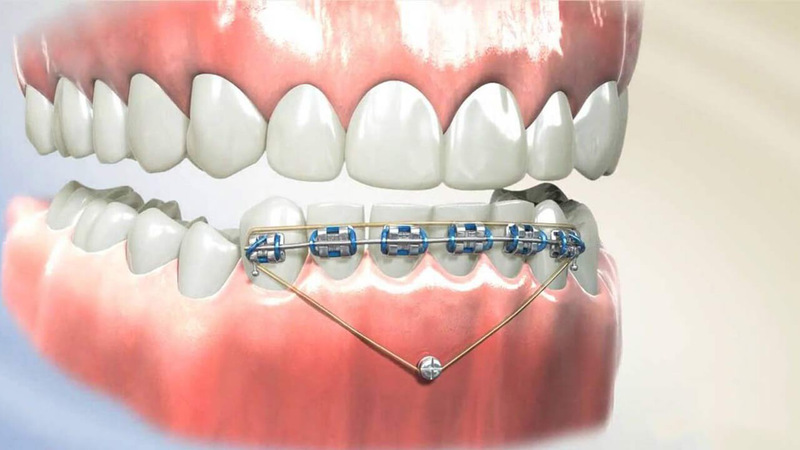 Các phương pháp đóng khoảng trong niềng răng