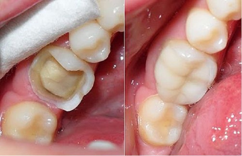 Các phương pháp hàn răng trám răng phổ biến