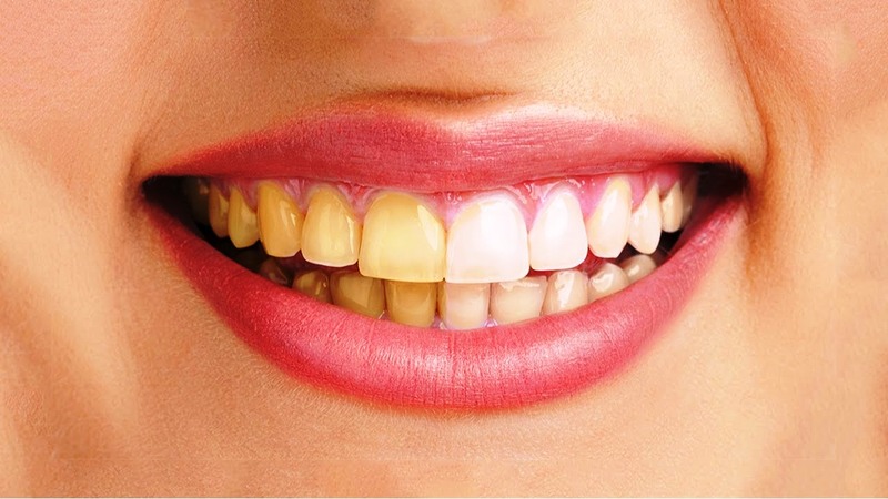 Hàn – trám răng để cải thiện tình trạng màu răng