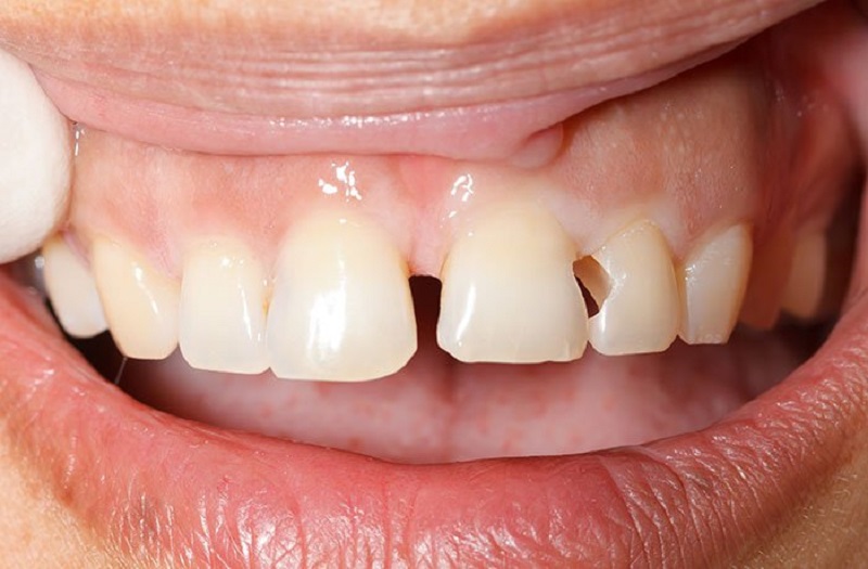 Hàn – trám răng trong trường hợp răng thưa, sứt mẻ