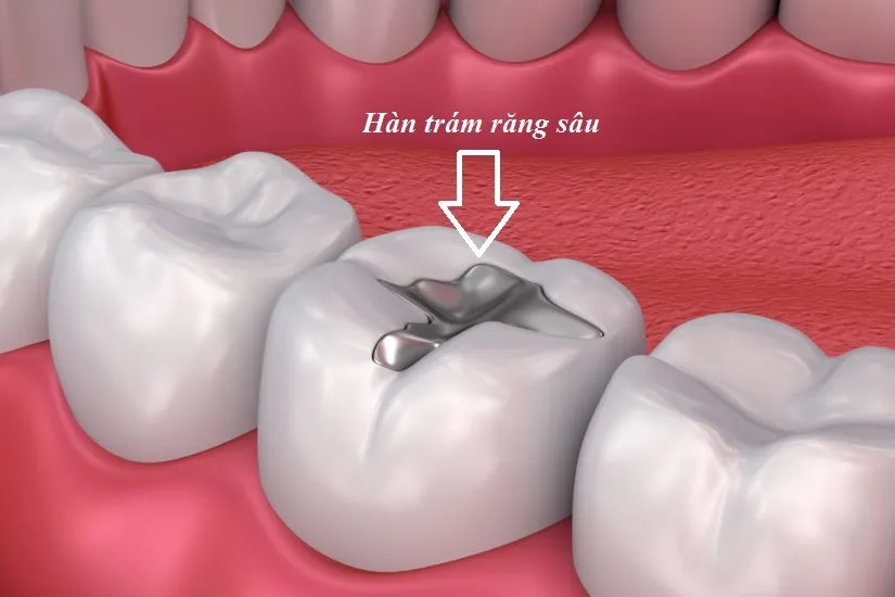 Hàn – trám răng trong điều trị sâu răng