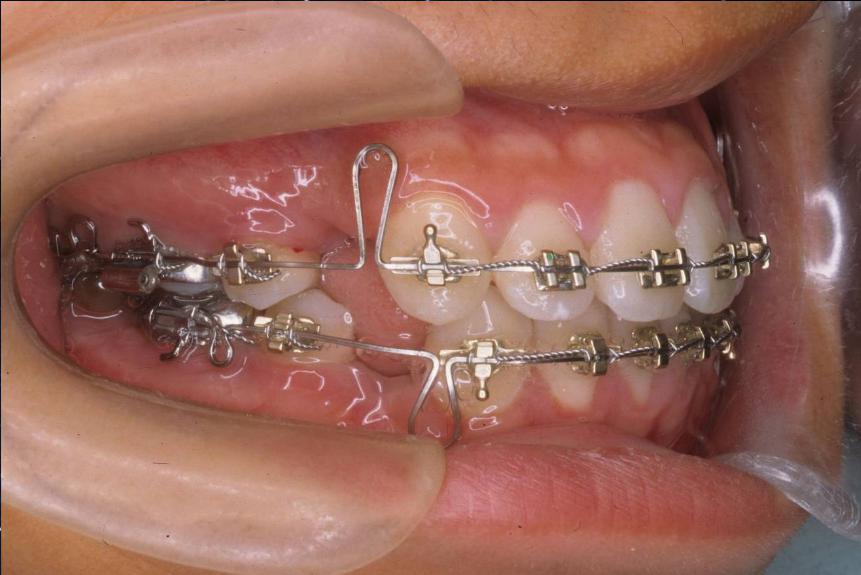 Kéo cụm 4 răng cửa hàm trên