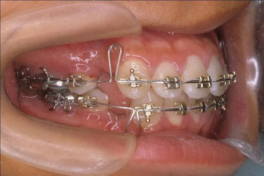 Kéo cụm 4 răng cửa hàm trên