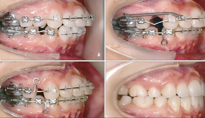 Việc kéo 4 răng cửa diễn ra ở giai đoạn nào khi niềng?