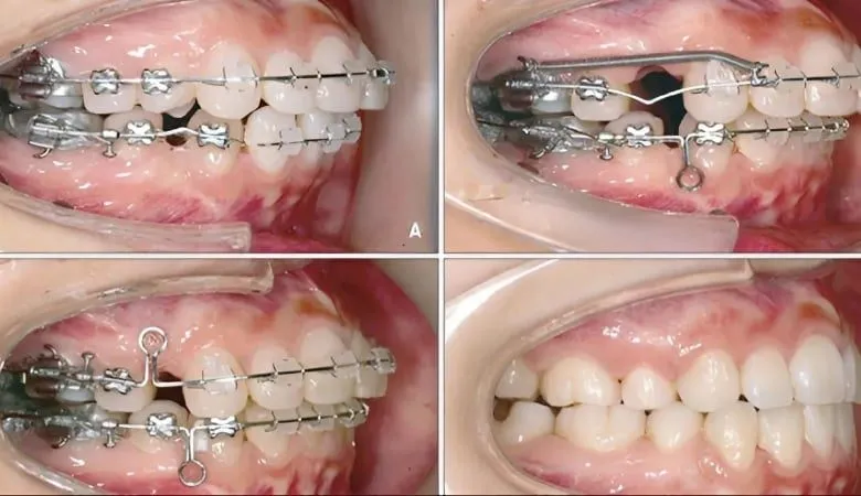 Việc kéo 4 răng cửa diễn ra ở giai đoạn nào khi niềng?