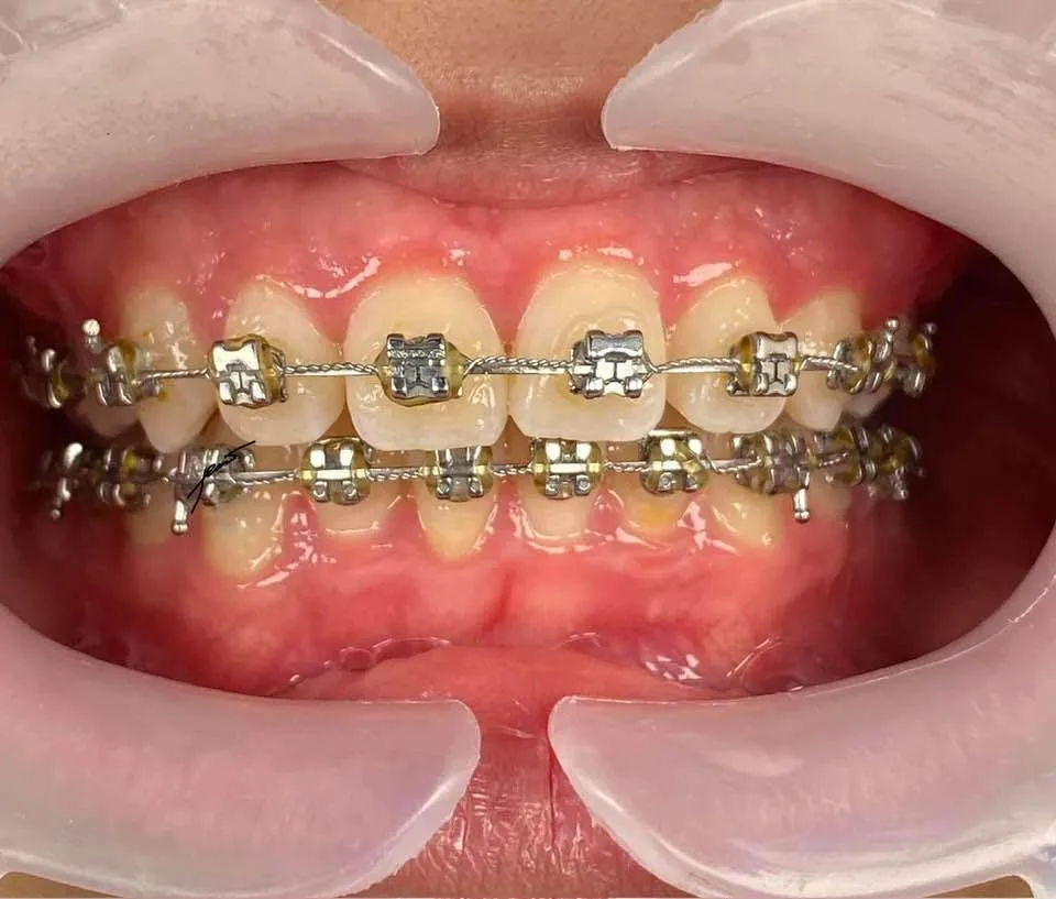 Giai đoạn 4: Theo dõi sự dịch chuyển của răng