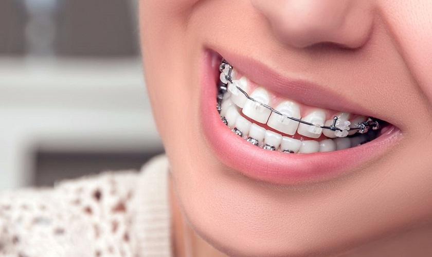 Giai đoạn đóng khoảng trong niềng răng diễn ra thế nào?