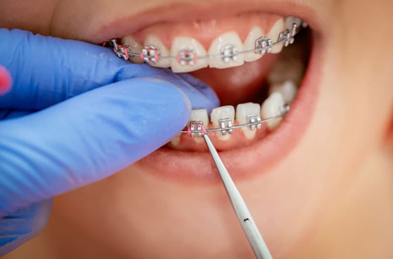 Đóng khoảng niềng răng mất bao lâu?
