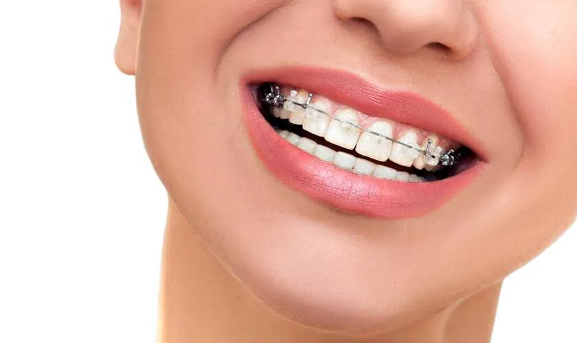 Niềng răng 1 hàm là gì?