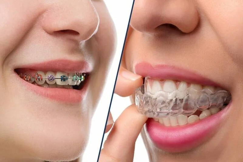 Ưu điểm của phương pháp niềng răng không mắc cài