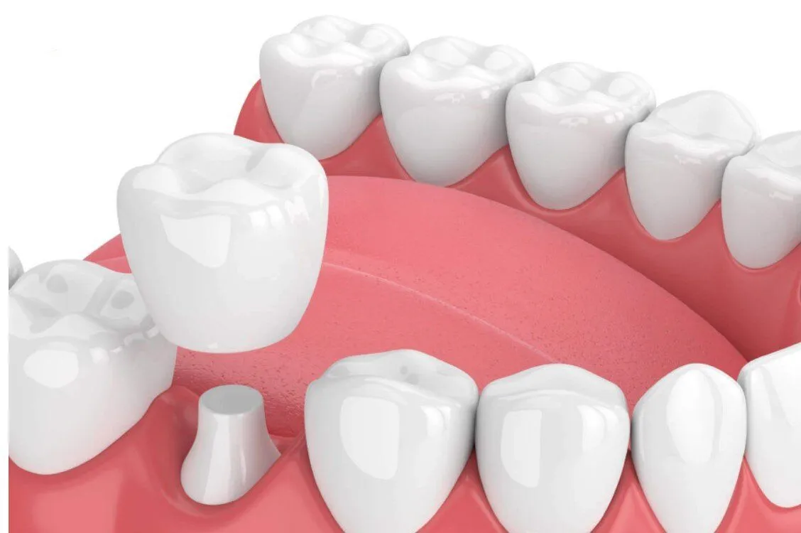 Phương pháp bọc răng sứ chỉnh hô