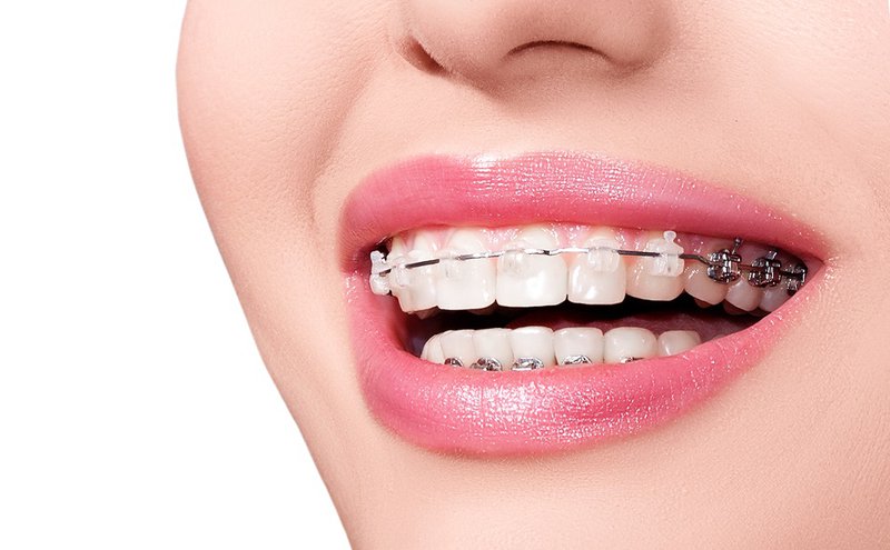 Phương pháp niềng răng chỉnh hô
