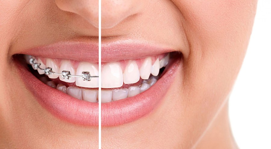 Răng hô nên niềng hay bọc sứ?