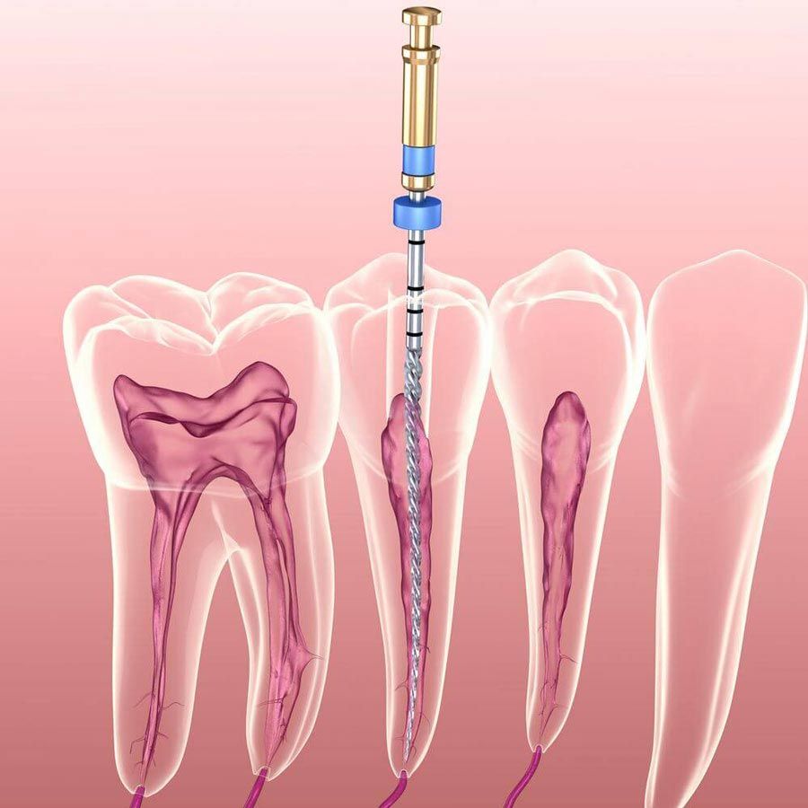 Chữa tủy răng - Điều trị răng vĩnh viễn của trẻ bị sâu