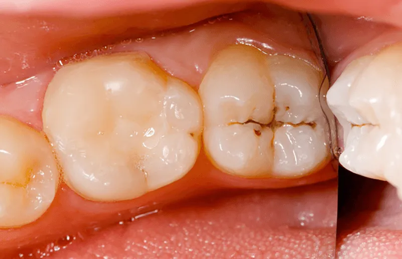 Giai đoạn bắt đầu khởi phát sâu răng vĩnh viễn