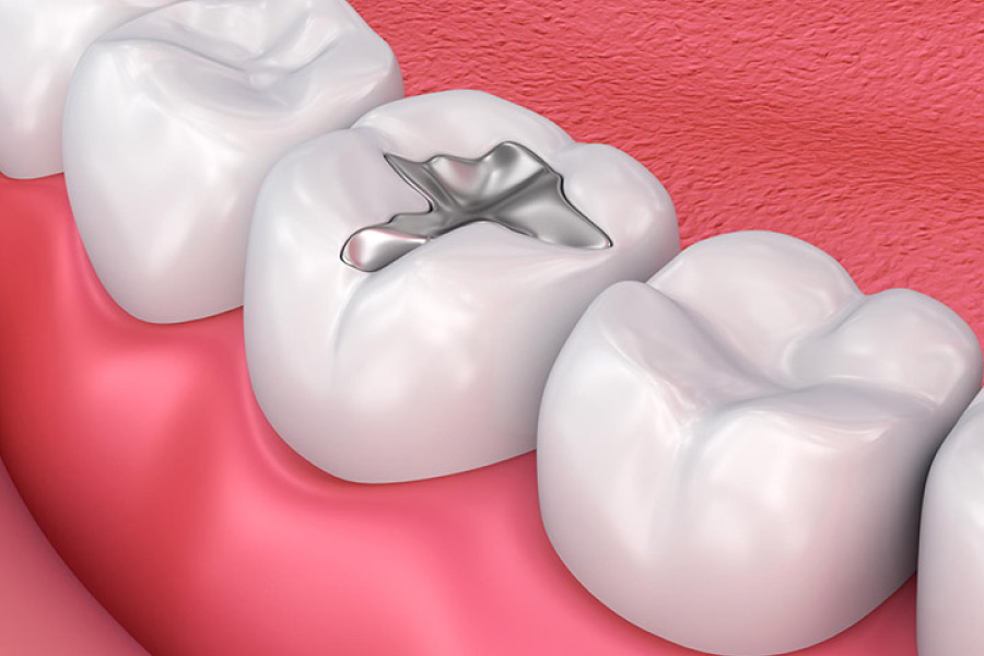 Trám răng vĩnh viễn - Điều trị răng vĩnh viễn của trẻ bị sâu