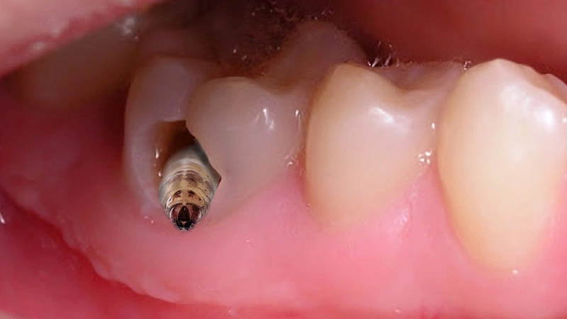 Các dấu hiệu của việc răng vĩnh viễn của trẻ bị sâu