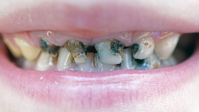 Giai đoạn răng vĩnh viễn của trẻ bị sâu năng