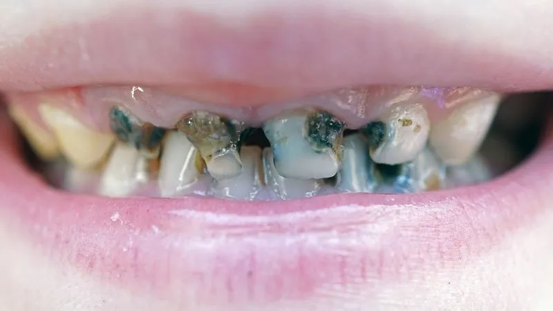 Giai đoạn răng vĩnh viễn của trẻ bị sâu năng