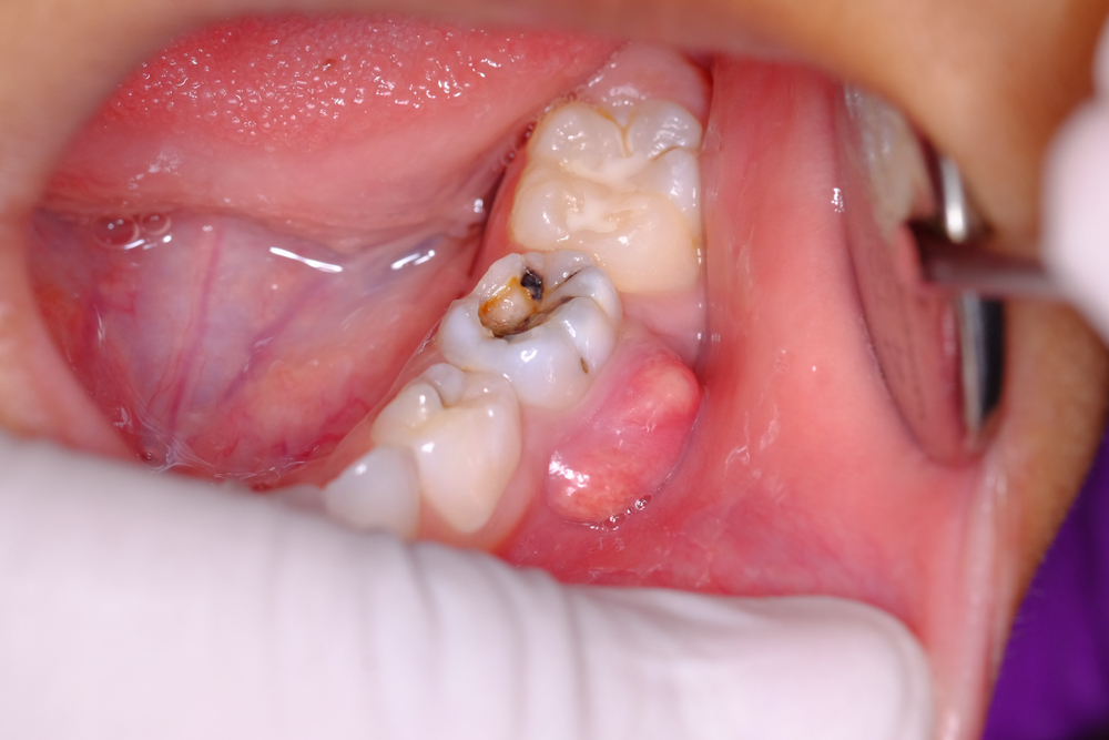 Giai đoạn sâu răng phát triển và tổn thương mô răng