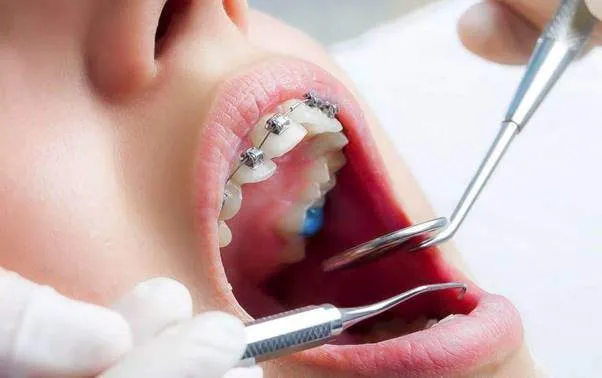 Siết răng khi niềng có đau không?