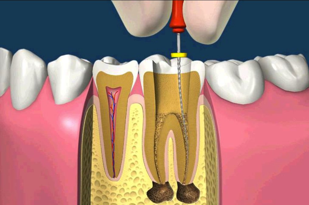 Điều trị tủy răng (Nội nha)
