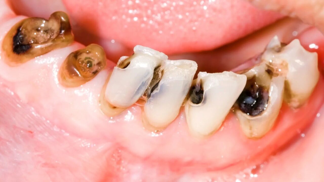 Vì sao nhiều người không đi nhổ răng sâu?