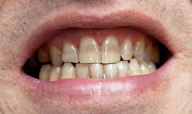 Có thể xuất hiện tác dụng phụ sau khi tẩy trắng