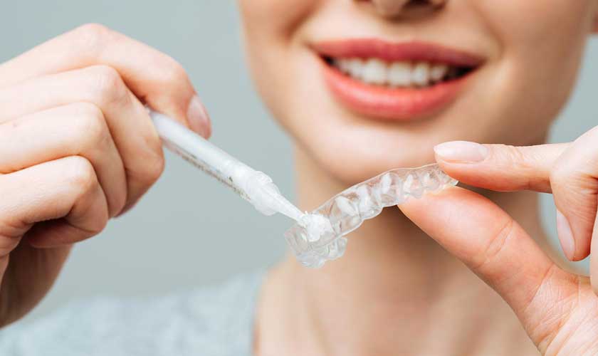 Tẩy trắng răng tại nhà giữ được bao lâu?