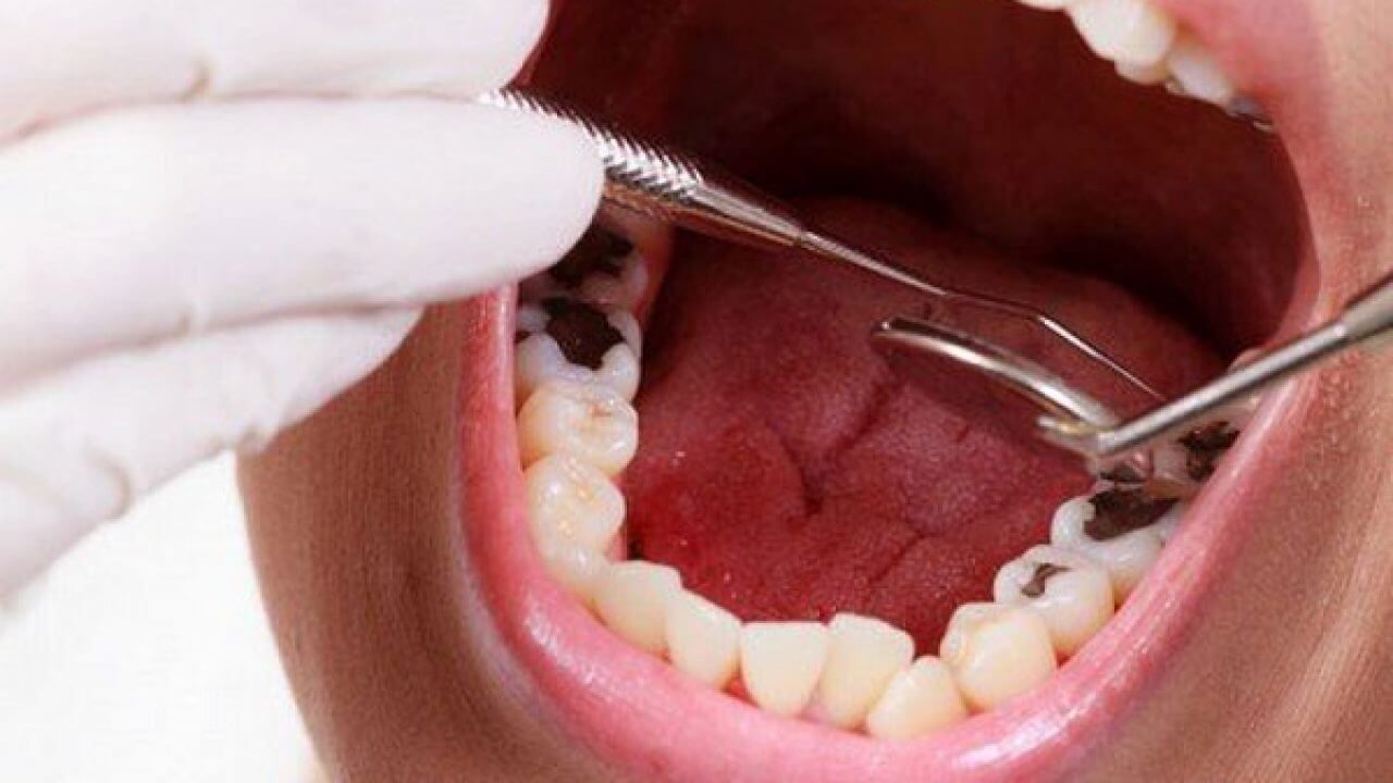 Nguyên nhân trẻ bị sâu răng ăn vào tủy