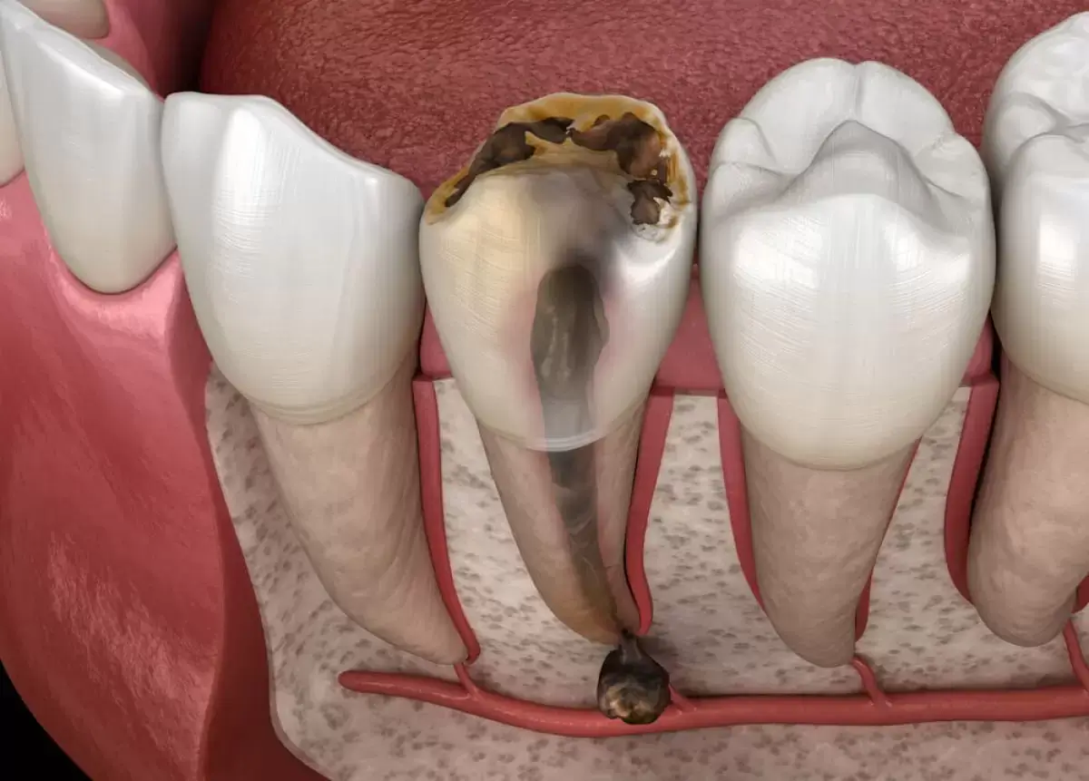 Dấu hiệu nhận biết trẻ bị sâu răng ăn vào tủy