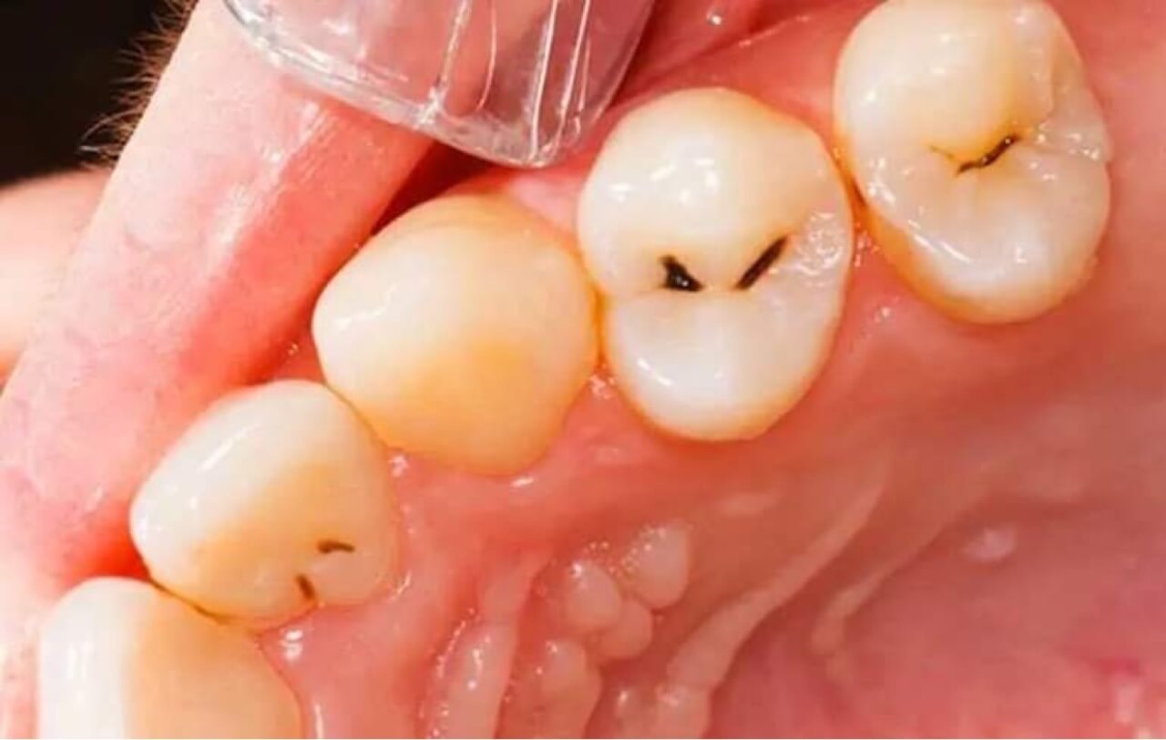 Biến chứng khi trẻ bị sâu răng ăn vào tủy