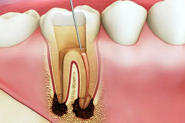 Giải pháp điều trị khi trẻ bị sâu răng ăn vào tủy