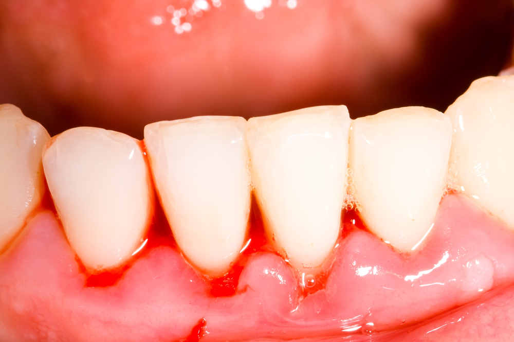 Có thể trị dứt điểm chảy máu chân răng được không?