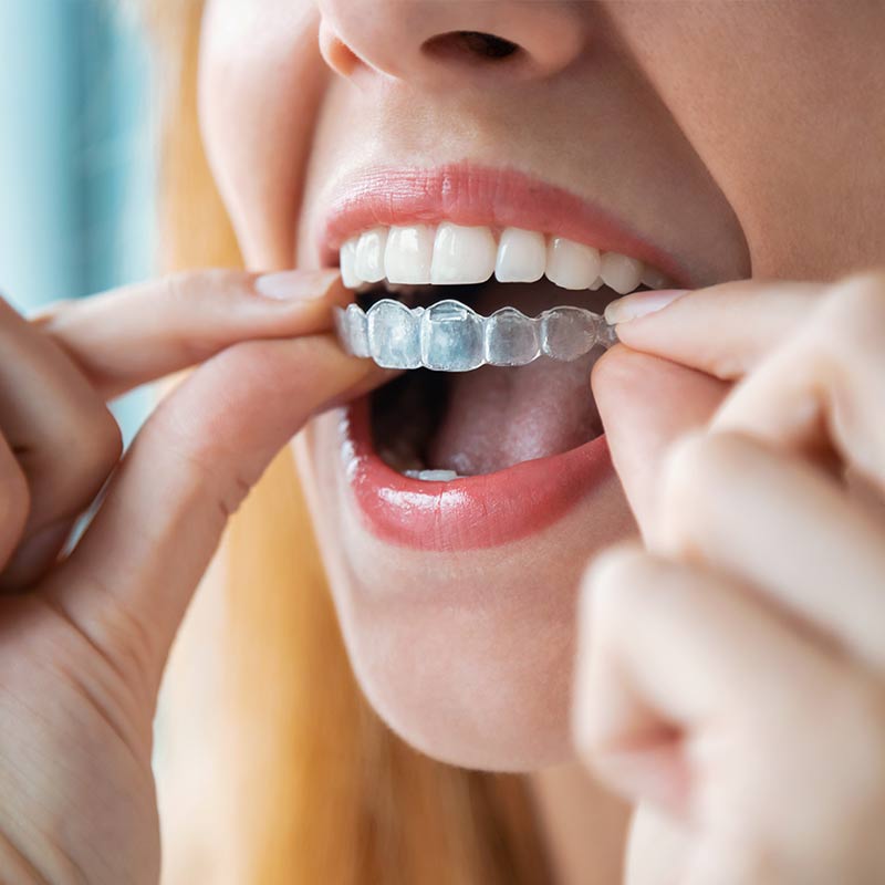 Những lưu ý liên quan đến tư thế ngủ khi niềng răng