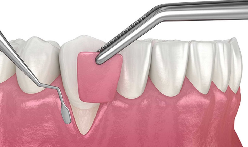 Trường hợp lợi phì đại ở mức độ nặng