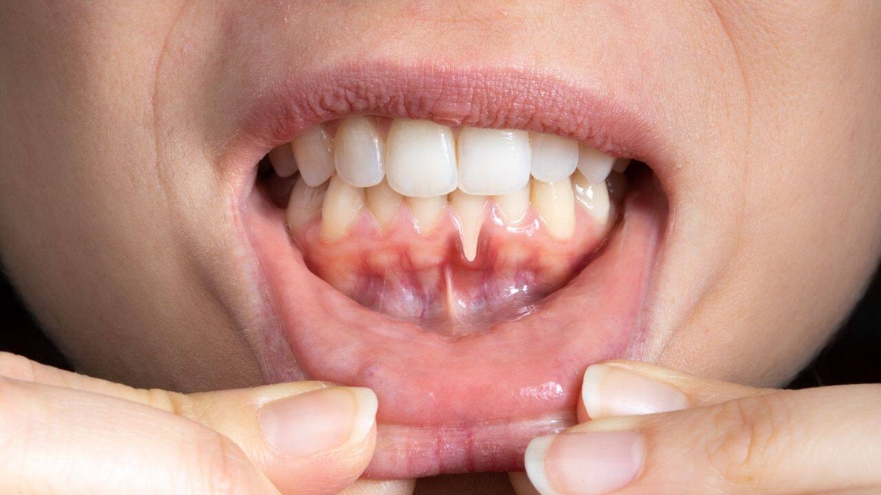 Không điều trị viêm lợi kịp thời