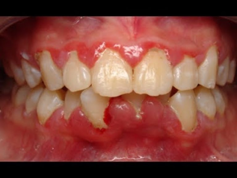 Những dấu hiệu của hiện tượng lợi phì đại