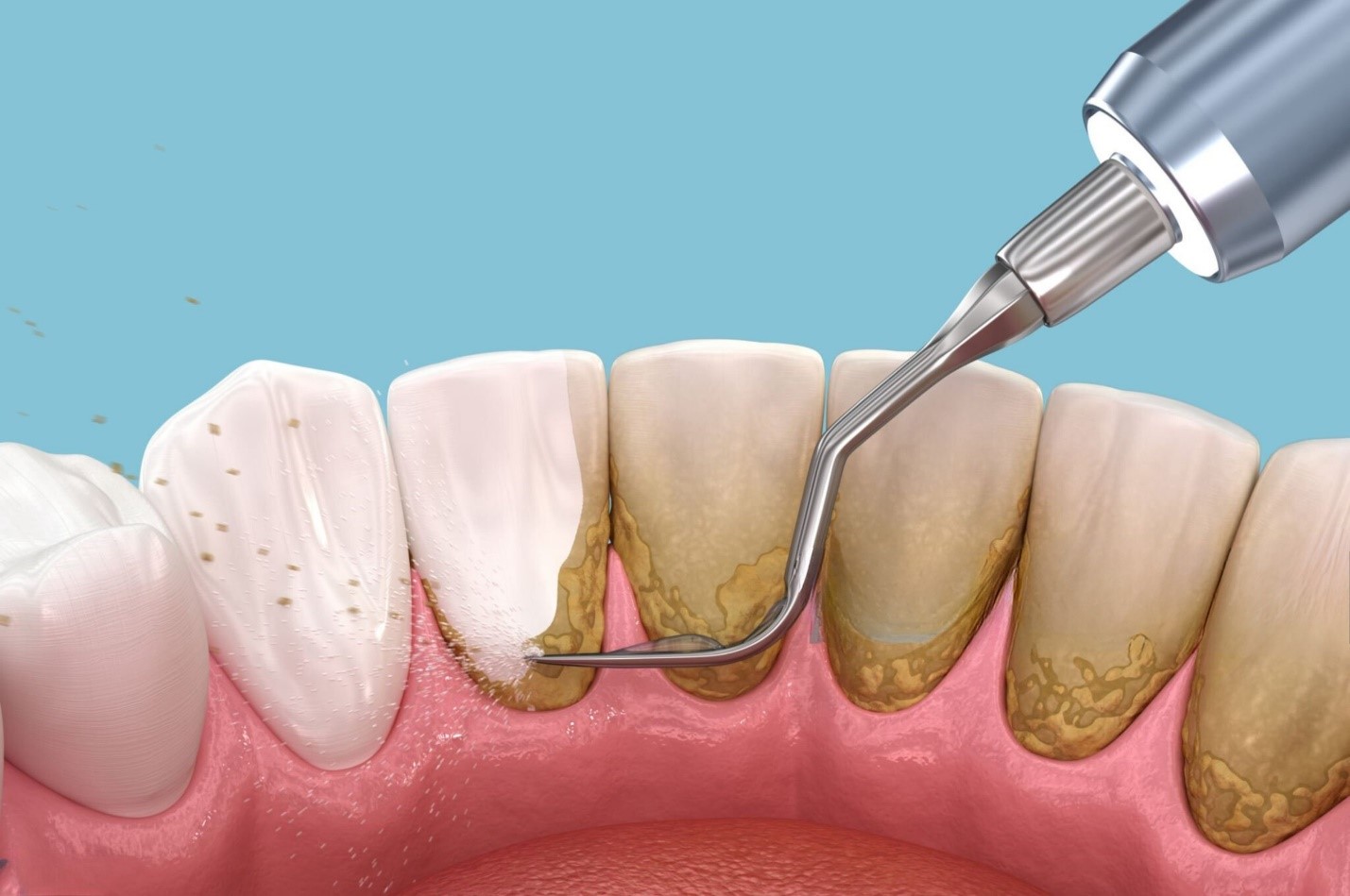 Cạo vôi răng định kỳ tại nha khoa