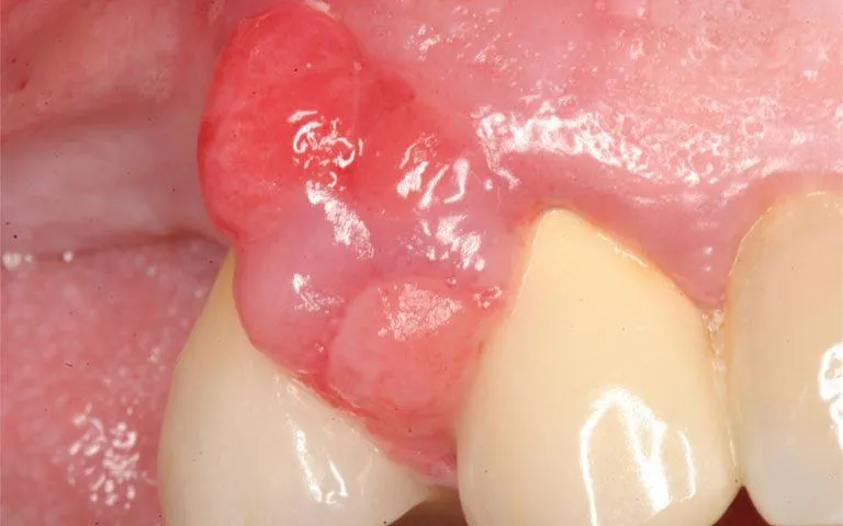 Nguyên nhân gây ra viêm lợi phì đại khi mang thai